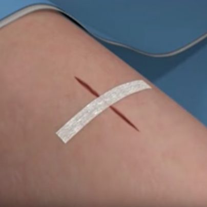 The 3M Steri Strips Are the Future of Stitches